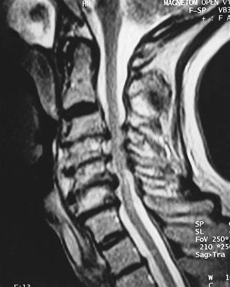 thoracic spondylosis with cord compression.